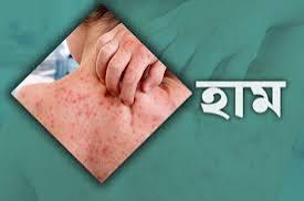 চাঁপাইনবাবগঞ্জে হামের টিকাদান প্রায় লক্ষ্যমাত্রা পূরণ, রোগী ১০১৭ জন
